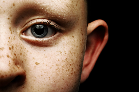 sundicators freckles