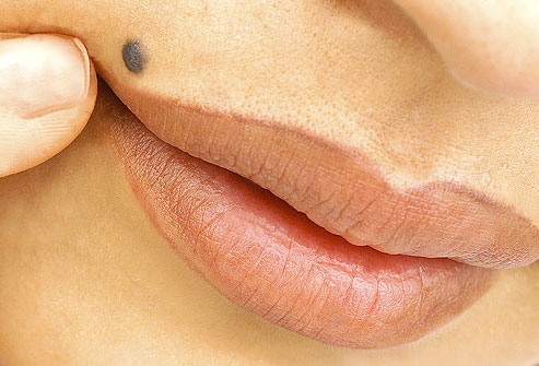 Moles: are they all cancerous